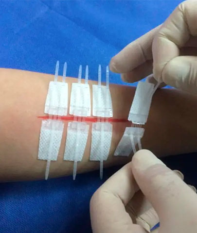 https://memcirurgica.com.br/wp-content/uploads/2022/04/sequa-skin-closure-curativo-para-ferida-cirurgica.jpg?utm_source=chatgpt.com