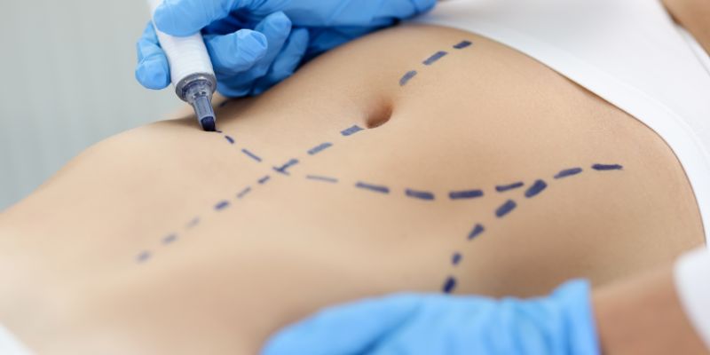 Caneta Cirúrgica Estéril